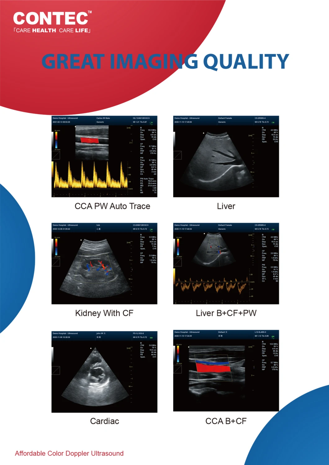 Contec Hospital Equipment Color Doppler Ultrasound Diagnostic System